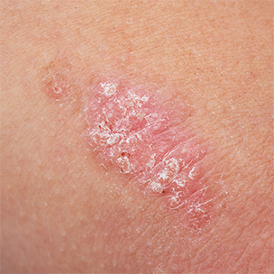 Plaque psoriasis on skin
