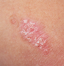 Psoriasis en placas en la piel