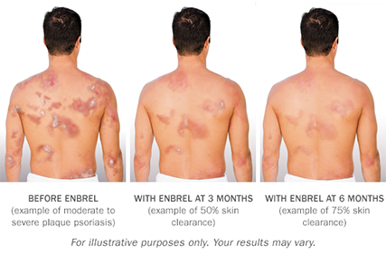 Los pacientes que toman Enbrel pueden experimentar cambios en los síntomas cutáneos con el tiempo, lo que produce una piel más sana.