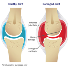 Illustration of healthy joint versus damaged joint