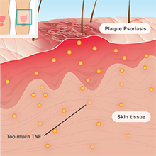 Illustration of plaque psoriasis in the body